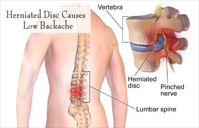 symptoms of prolapse of intervertebral disc