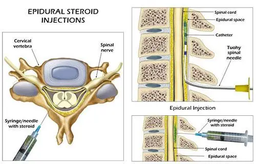 Epidural 1