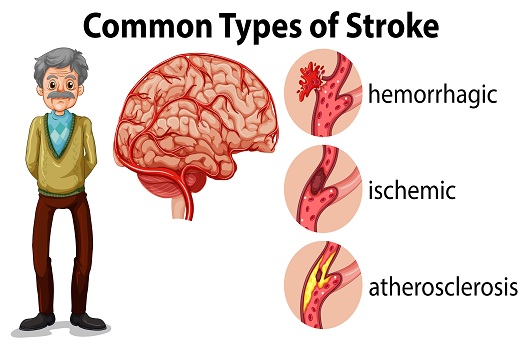 Kinds of Strokes