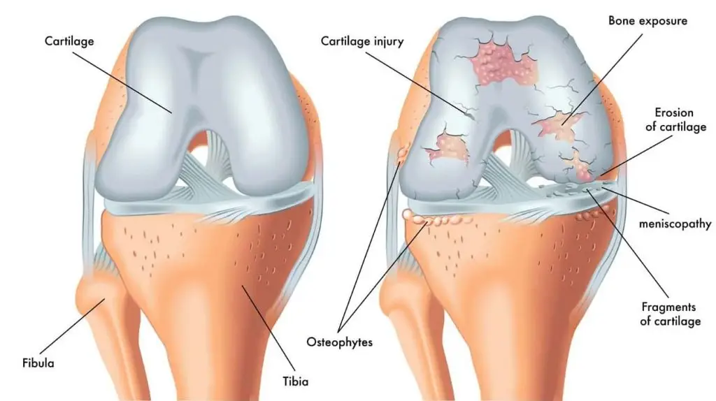 Osteoarthritis Knee