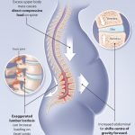 obesity and low back pain