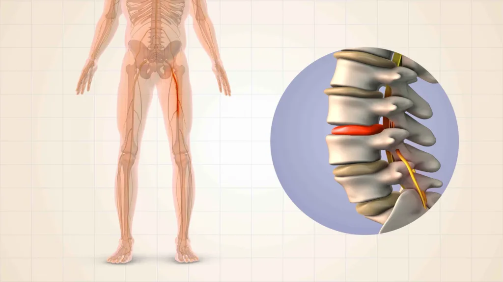 sciatic nerve pain 