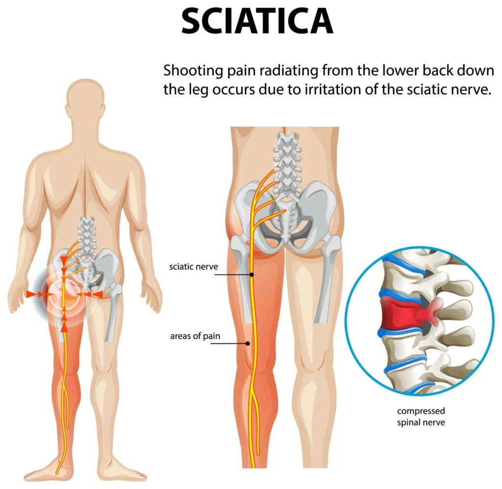 sciatica pain 
